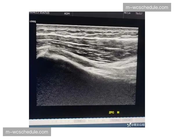 深圳队外援约翰逊确诊右侧腘绳肌内侧肌腱断裂，预计康复8周